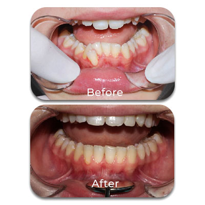 before-after-5