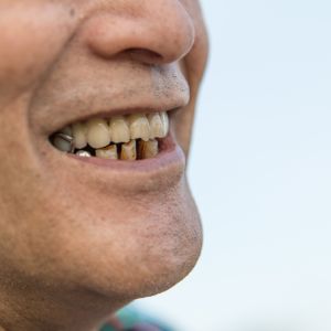 Missing or damaged multiple teeth